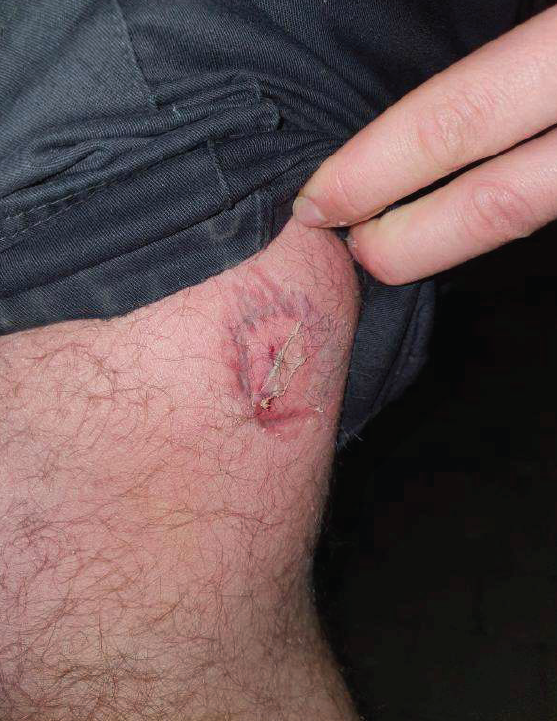Injury to officer's leg